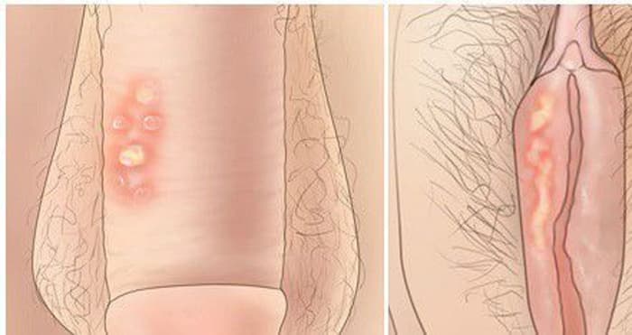 Obat Untuk Sipilis Dan Gonore