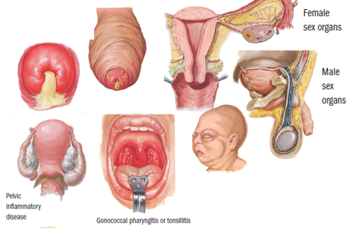 Obat Antibiotik Gejala Sipilis