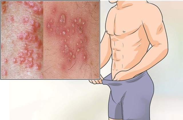 Obat Sipilis Farmasi