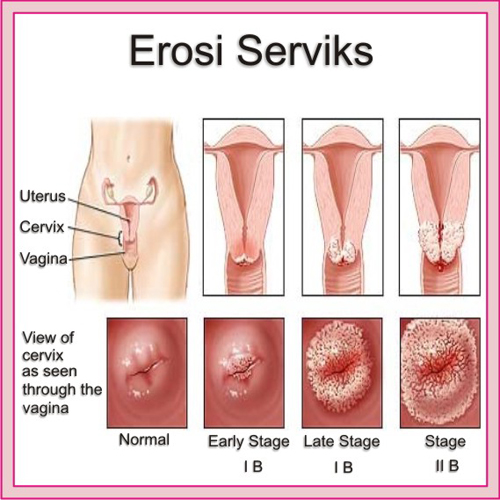 Obat Sipilis Ibu Hamil